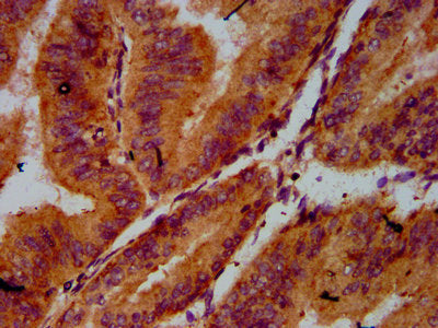 IHC image of CSB-PA004984LA01HU diluted at 1:500 and staining in paraffin-embedded human endometrial cancer performed on a Leica BondTM system. After dewaxing and hydration, antigen retrieval was mediated by high pressure in a citrate buffer (pH 6...