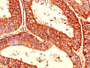 Immunohistochemistry of paraffin-embedded human endometrial cancer using CSB-PA005004LA01HU at dilution of 1:100