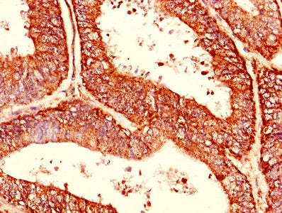 Immunohistochemistry of paraffin-embedded human endometrial cancer using CSB-PA005004LA01HU at dilution of 1:100