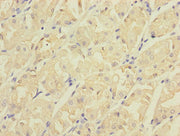 Immunohistochemistry of paraffin-embedded human gastric cancer using CSB-PA005013LA01HU at dilution of 1:100