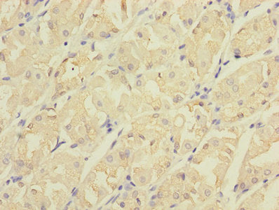 Immunohistochemistry of paraffin-embedded human gastric cancer using CSB-PA005013LA01HU at dilution of 1:100