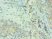 Immunohistochemistry of paraffin-embedded human breast cancer using CSB-PA005039ESR1HU at dilution of 1:100