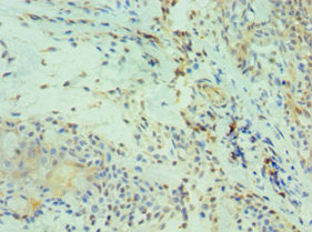 Immunohistochemistry of paraffin-embedded human breast cancer using CSB-PA005039ESR1HU at dilution of 1:100