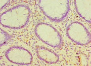 Immunohistochemistry of paraffin-embedded human colon cancer using CSB-PA005041ESR2HU at dilution of 1:100