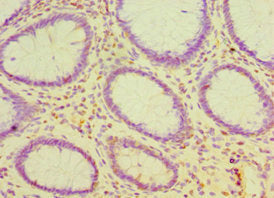 Immunohistochemistry of paraffin-embedded human colon cancer using CSB-PA005041ESR2HU at dilution of 1:100