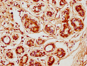 IHC image of CSB-PA005064LA01HU diluted at 1:600 and staining in paraffin-embedded human breast cancer performed on a Leica BondTM system. After dewaxing and hydration, antigen retrieval was mediated by high pressure in a citrate buffer (pH 6.0)....