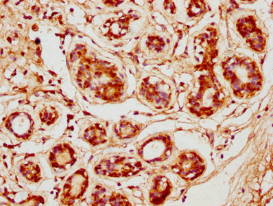 IHC image of CSB-PA005064LA01HU diluted at 1:600 and staining in paraffin-embedded human breast cancer performed on a Leica BondTM system. After dewaxing and hydration, antigen retrieval was mediated by high pressure in a citrate buffer (pH 6.0)....