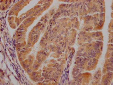 IHC image of CSB-PA005074LA01HU diluted at 1:300 and staining in paraffin-embedded human endometrial cancer performed on a Leica BondTM system. After dewaxing and hydration, antigen retrieval was mediated by high pressure in a citrate buffer (pH 6...