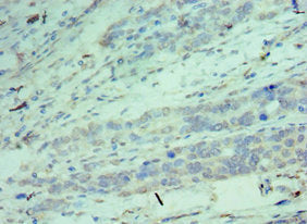 Immunohistochemistry of paraffin-embedded human endometrial cancer using CSB-PA005079ESR1HU at dilution of 1:100