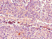 Immunohistochemistry of paraffin-embedded human cervical cancer using CSB-PA005089LA01HU at dilution of 1:100