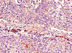 Immunohistochemistry of paraffin-embedded human cervical cancer using CSB-PA005089LA01HU at dilution of 1:100