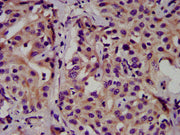 IHC image of CSB-PA005158LA01HU diluted at 1:500 and staining in paraffin-embedded human liver cancer performed on a Leica BondTM system. After dewaxing and hydration, antigen retrieval was mediated by high pressure in a citrate buffer (pH 6.0). S...