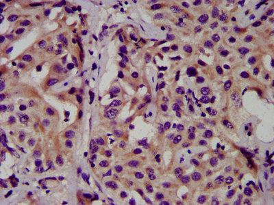 IHC image of CSB-PA005158LA01HU diluted at 1:500 and staining in paraffin-embedded human liver cancer performed on a Leica BondTM system. After dewaxing and hydration, antigen retrieval was mediated by high pressure in a citrate buffer (pH 6.0). S...