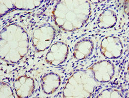 Immunohistochemistry of paraffin-embedded human colon cancer using CSB-PA005163ESR2HU at dilution of 1:100
