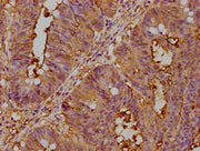 IHC image of CSB-PA005165LA01HU diluted at 1:400 and staining in paraffin-embedded human colon cancer performed on a Leica BondTM system. After dewaxing and hydration, antigen retrieval was mediated by high pressure in a citrate buffer (pH 6.0). S...