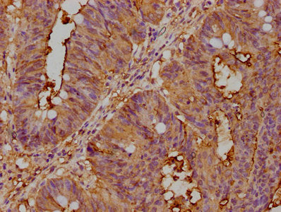 IHC image of CSB-PA005165LA01HU diluted at 1:400 and staining in paraffin-embedded human colon cancer performed on a Leica BondTM system. After dewaxing and hydration, antigen retrieval was mediated by high pressure in a citrate buffer (pH 6.0). S...