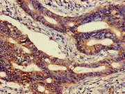 Immunohistochemistry of paraffin-embedded human colon cancer using CSB-PA005167LA01HU at dilution of 1:100