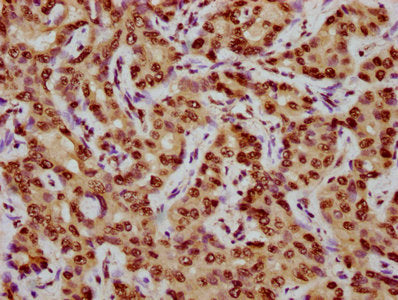 IHC image of CSB-PA005205OA07nphHU diluted at 1:10 and staining in paraffin-embedded human liver cancer performed on a Leica BondTM system. After dewaxing and hydration, antigen retrieval was mediated by high pressure in a citrate buffer (pH 6.0)....