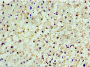 Immunohistochemistry of paraffin-embedded human liver cancer using CSB-PA005220ESR2HU at dilution of 1:100