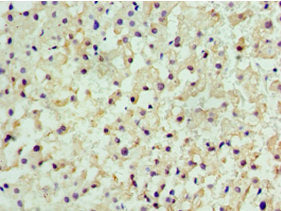 Immunohistochemistry of paraffin-embedded human liver cancer using CSB-PA005220ESR2HU at dilution of 1:100