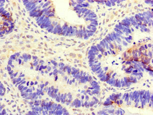 Immunohistochemistry of paraffin-embedded human ovarian cancer using CSB-PA005241LA01HU at dilution of 1:100