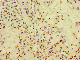 Immunohistochemistry of paraffin-embedded human breast cancer using CSB-PA005271ESR2HU at dilution of 1:100