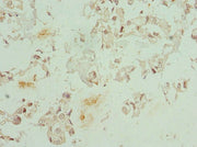 Immunohistochemistry of paraffin-embedded human bladder cancer using CSB-PA005272DSR1HU at dilution of 1:100
