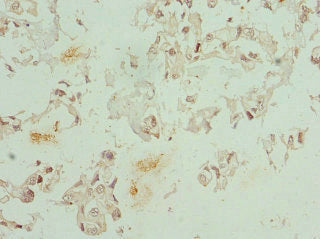Immunohistochemistry of paraffin-embedded human bladder cancer using CSB-PA005272DSR1HU at dilution of 1:100