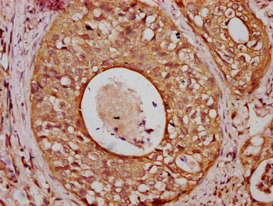 IHC image of CSB-PA005302LA01HU diluted at 1:800 and staining in paraffin-embedded human cervical cancer performed on a Leica BondTM system. After dewaxing and hydration, antigen retrieval was mediated by high pressure in a citrate buffer (pH 6.0)...