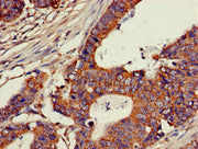 Immunohistochemistry of paraffin-embedded human colon cancer using CSB-PA005307LA01HU at dilution of 1:100