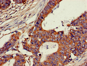 Immunohistochemistry of paraffin-embedded human colon cancer using CSB-PA005307LA01HU at dilution of 1:100