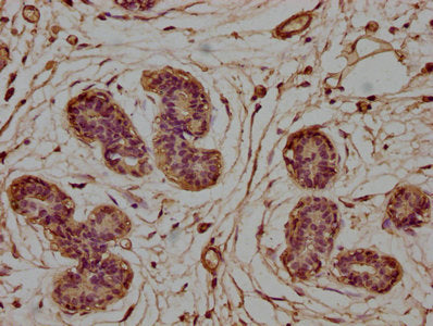 IHC image of CSB-PA005484LA01HU diluted at 1:100 and staining in paraffin-embedded human breast cancer performed on a Leica BondTM system. After dewaxing and hydration, antigen retrieval was mediated by high pressure in a citrate buffer (pH 6.0)....