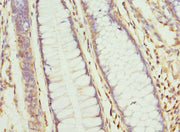 Immunohistochemistry of paraffin-embedded human colon cancer using CSB-PA005486ESR1HU at dilution of 1:100