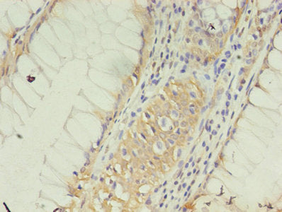 Immunohistochemistry of paraffin-embedded human colon cancer using CSB-PA005495EA01HU at dilution of 1:100