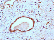 IHC image of CSB-PA005498LA01HU diluted at 1:200 and staining in paraffin-embedded human gastric cancer performed on a Leica BondTM system. After dewaxing and hydration, antigen retrieval was mediated by high pressure in a citrate buffer (pH 6.0)....