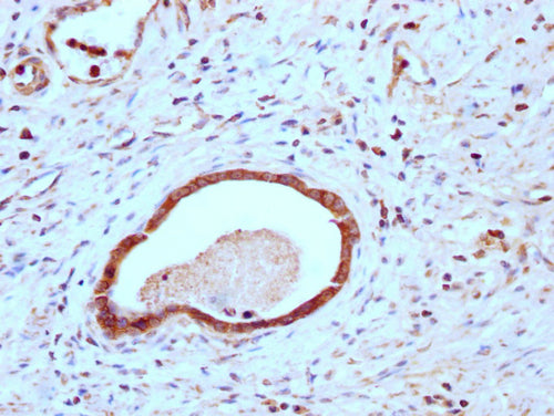 IHC image of CSB-PA005498LA01HU diluted at 1:200 and staining in paraffin-embedded human gastric cancer performed on a Leica BondTM system. After dewaxing and hydration, antigen retrieval was mediated by high pressure in a citrate buffer (pH 6.0)....