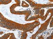 The image on the left is immunohistochemistry of paraffin-embedded Human colon cancer tissue using CSB-PA005512(ANAPC10 Antibody) at dilution 1/40, on the right is treated with fusion protein. (Original magnification: ×200)