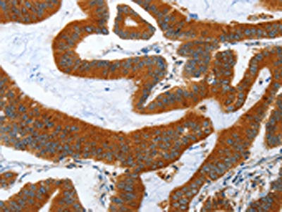 The image on the left is immunohistochemistry of paraffin-embedded Human colon cancer tissue using CSB-PA005512(ANAPC10 Antibody) at dilution 1/40, on the right is treated with fusion protein. (Original magnification: ×200)