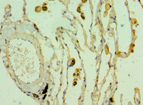 Immunohistochemistry of paraffin-embedded human lung cancer using CSB-PA005531ESR1HU at dilution of 1:100