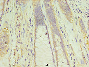 Immunohistochemistry of paraffin-embedded human colon cancer using CSB-PA005558ESR2HU at dilution of 1:100