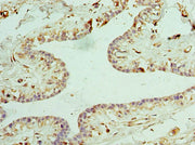 Immunohistochemistry of paraffin-embedded human breast cancer using CSB-PA005591DSR2HU at dilution of 1:100