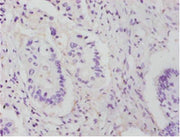 Immunohistochemistry of paraffin-embedded human colon cancer using CSB-PA00565A0Rb at dilution of 1:25