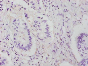 Immunohistochemistry of paraffin-embedded human colon cancer using CSB-PA00565A0Rb at dilution of 1:25