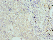 Immunohistochemistry of paraffin-embedded human lung cancer using CSB-PA005703ESR2HU at dilution of 1:100