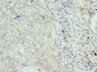 Immunohistochemistry of paraffin-embedded human lung cancer using CSB-PA005703ESR2HU at dilution of 1:100
