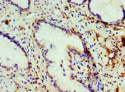 Immunohistochemistry of paraffin-embedded human cervical cancer using CSB-PA005711ESR1HU at dilution of 1:100