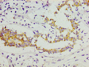 IHC image of CSB-PA005716LA01HU diluted at 1:300 and staining in paraffin-embedded human breast cancer performed on a Leica BondTM system. After dewaxing and hydration, antigen retrieval was mediated by high pressure in a citrate buffer (pH 6.0)....