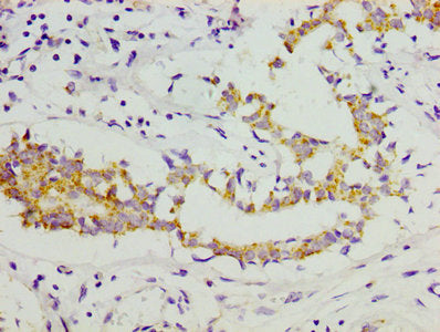 IHC image of CSB-PA005716LA01HU diluted at 1:300 and staining in paraffin-embedded human breast cancer performed on a Leica BondTM system. After dewaxing and hydration, antigen retrieval was mediated by high pressure in a citrate buffer (pH 6.0)....