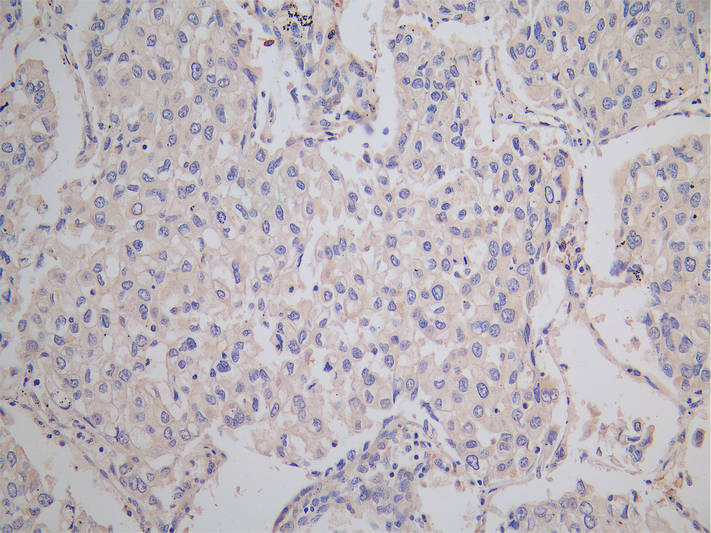 IHC image of CSB-PA005746LA01HU diluted at 1:150 and staining in paraffin-embedded human lung cancer performed on a Leica BondTM system. After dewaxing and hydration, antigen retrieval was mediated by high pressure in a citrate buffer (pH 6.0). Se...