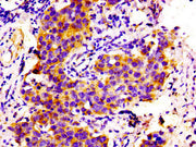 Immunohistochemistry of paraffin-embedded human bladder cancer using CSB-PA005752LA01HU at dilution of 1:100